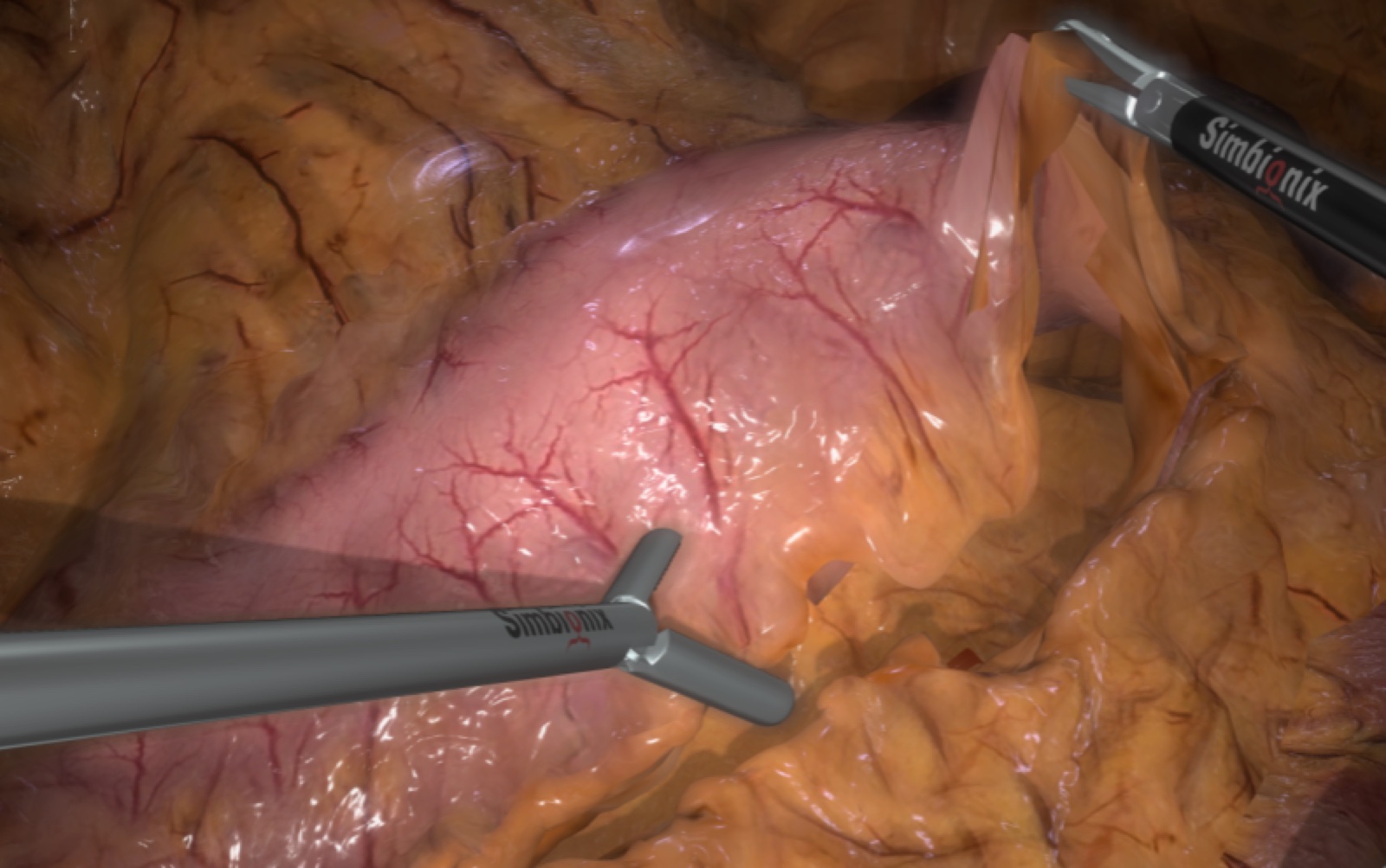 Simulationsansicht: Distale Gastrektomie