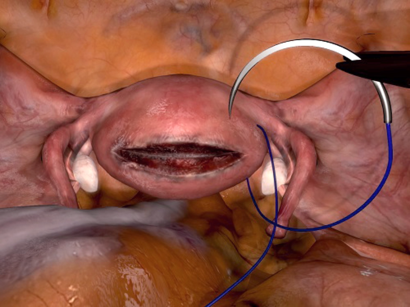 Simulationsansicht: Myomektomie